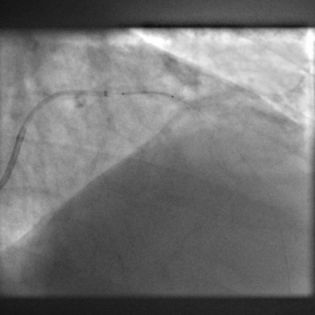 6. Διέλευση stent Synergy 3.0X16