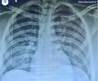 Chest X ray depicts a normal cardiothoracic ratio with prominent pulmonaryvasculature