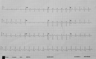 ECGs displays sinus tachycardia with incomplete RBBB