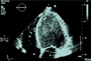 Echo apical 4CV with IV contrast agent. 